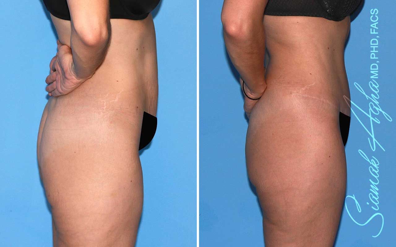 Tummy Tuck Before & After