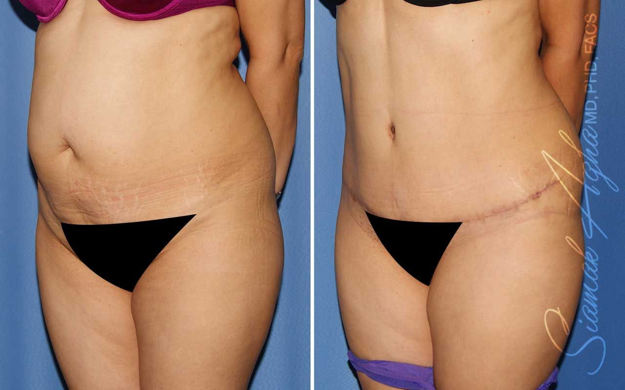Tummy Tuck Before & After