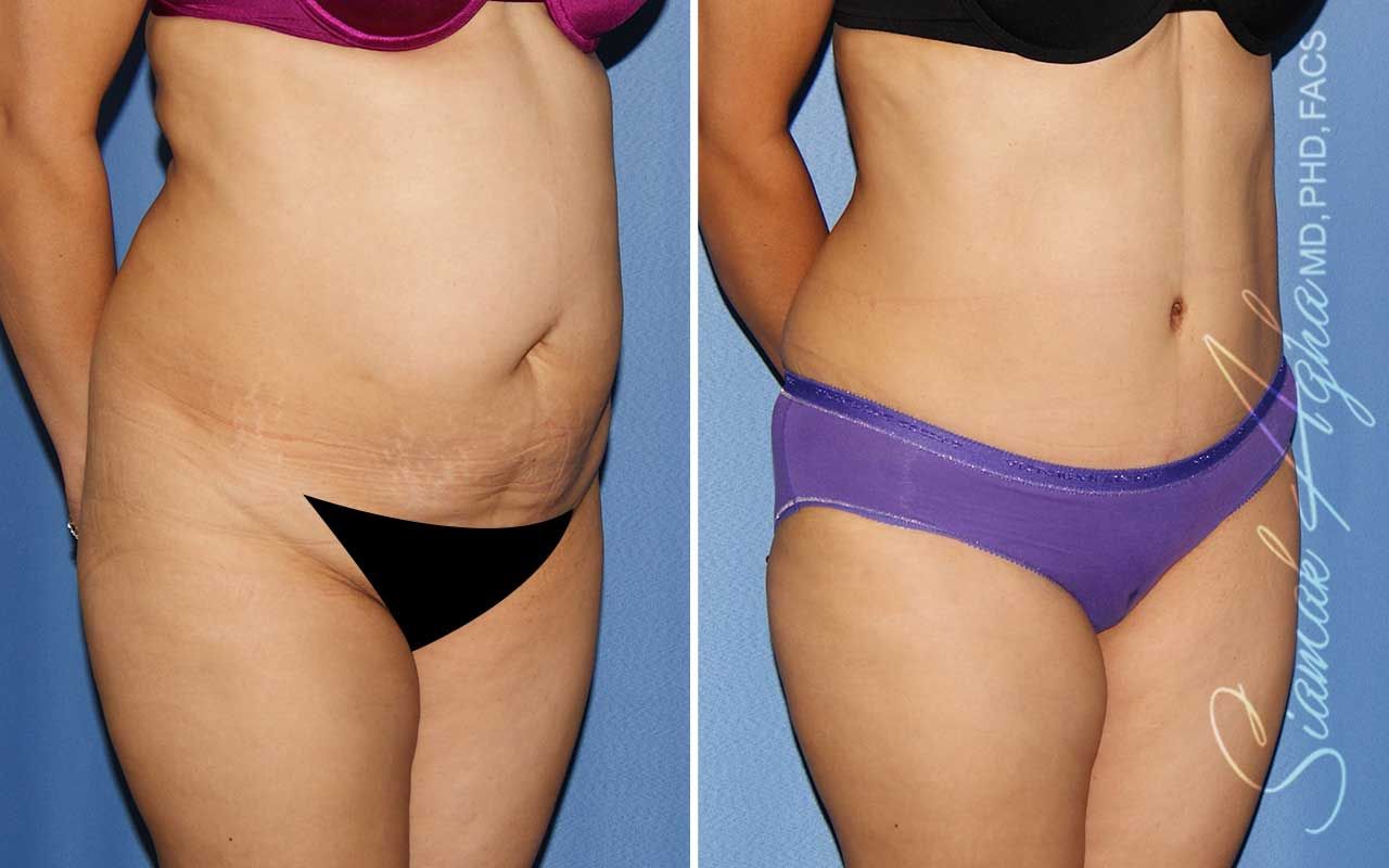Tummy Tuck Before & After
