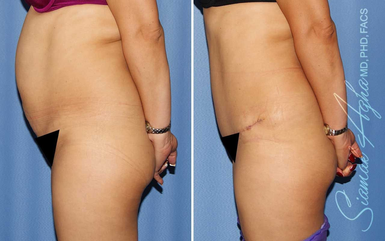 Tummy Tuck Before & After