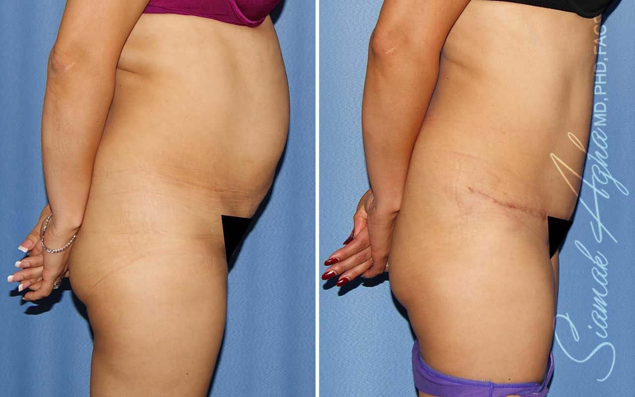 Tummy Tuck Before & After