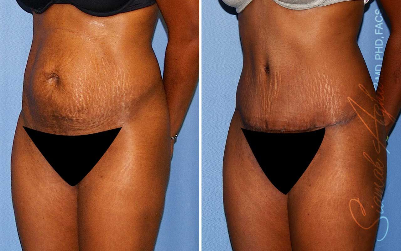 Tummy Tuck Before & After