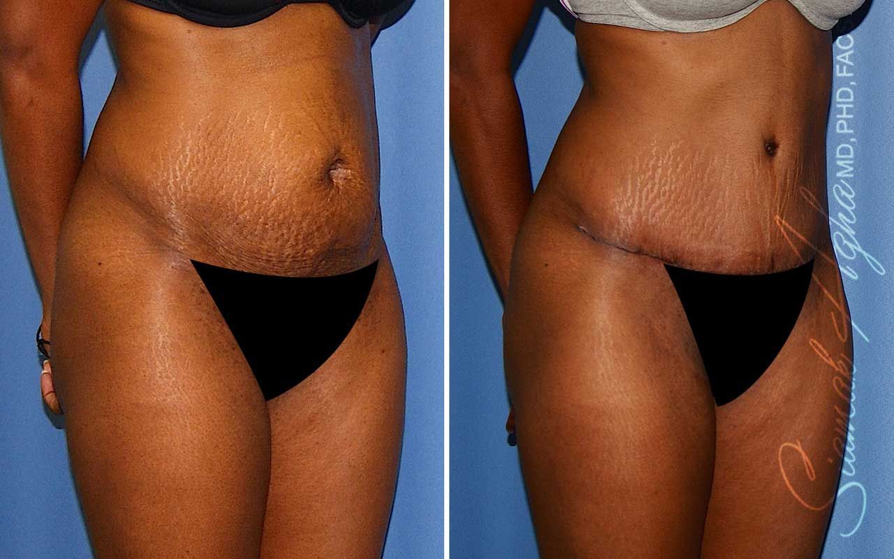 Tummy Tuck Before & After