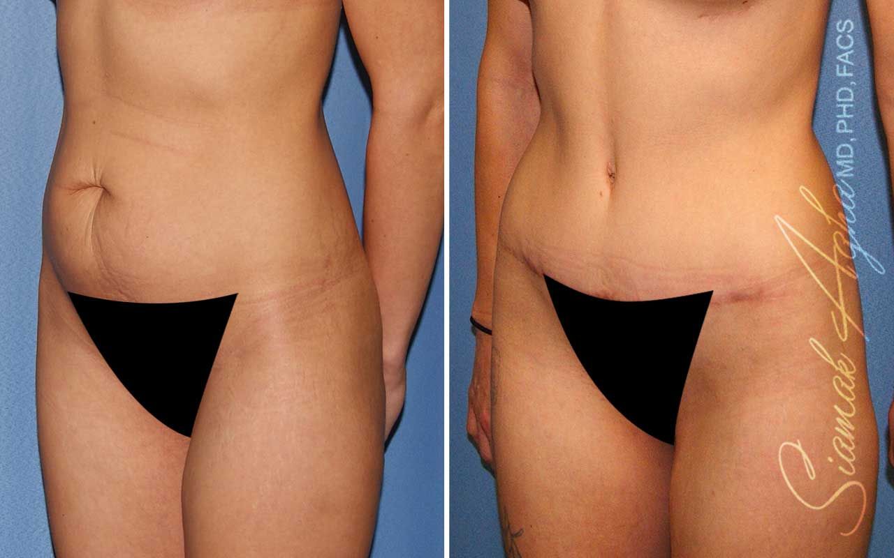 Tummy Tuck Before & After