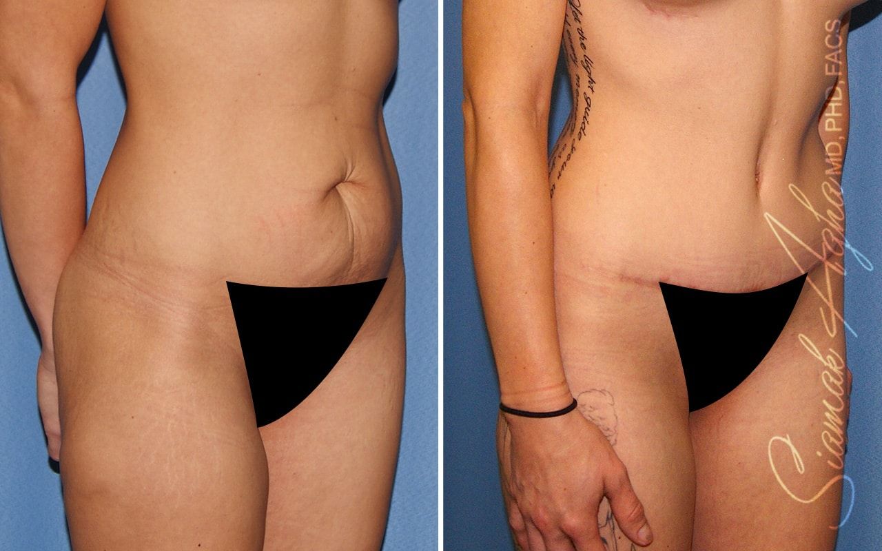 Tummy Tuck Before & After