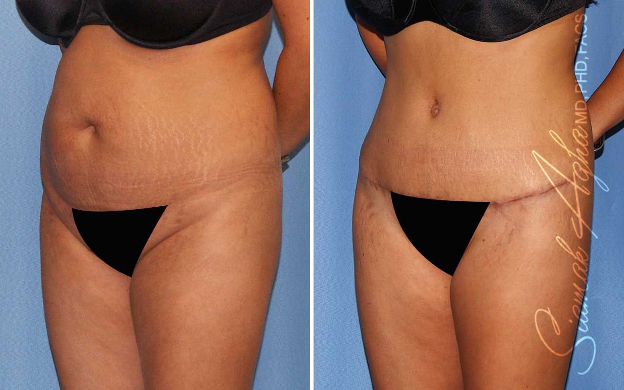 Tummy Tuck Before & After