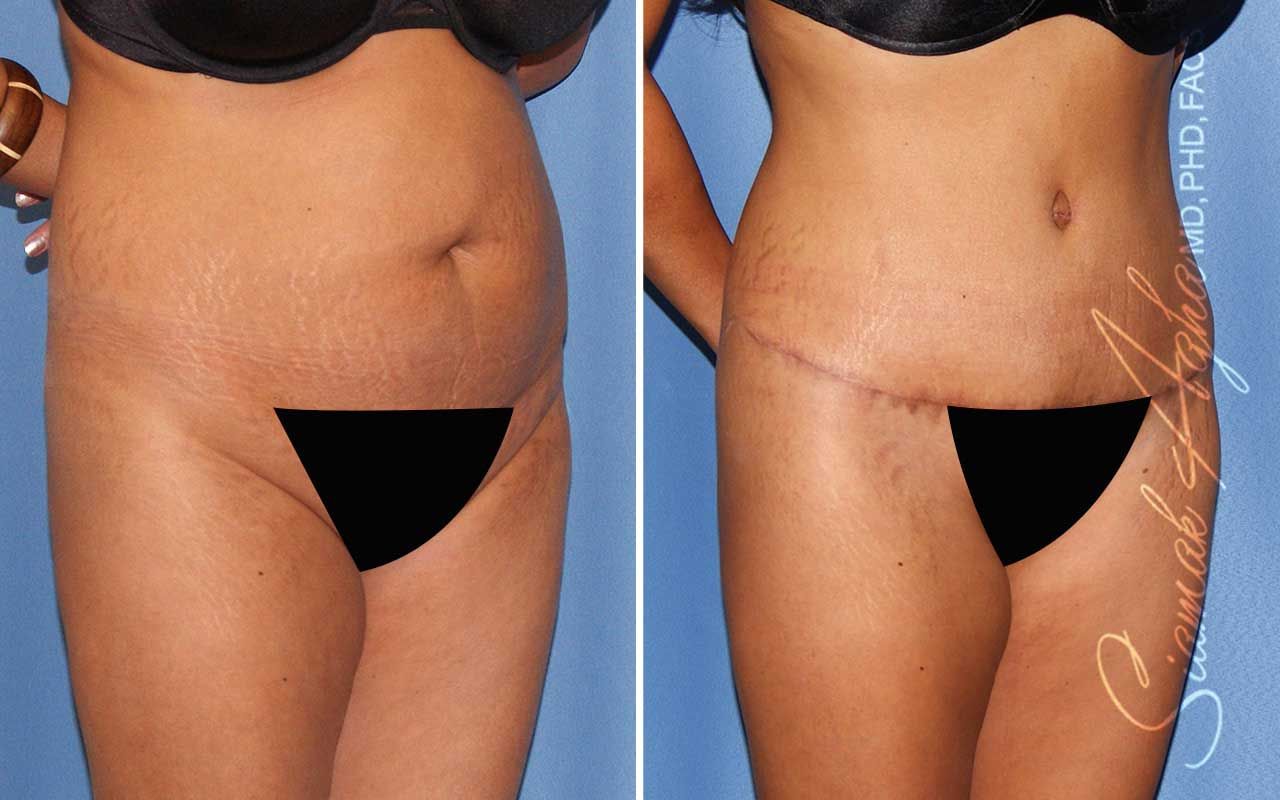 Tummy Tuck Before & After