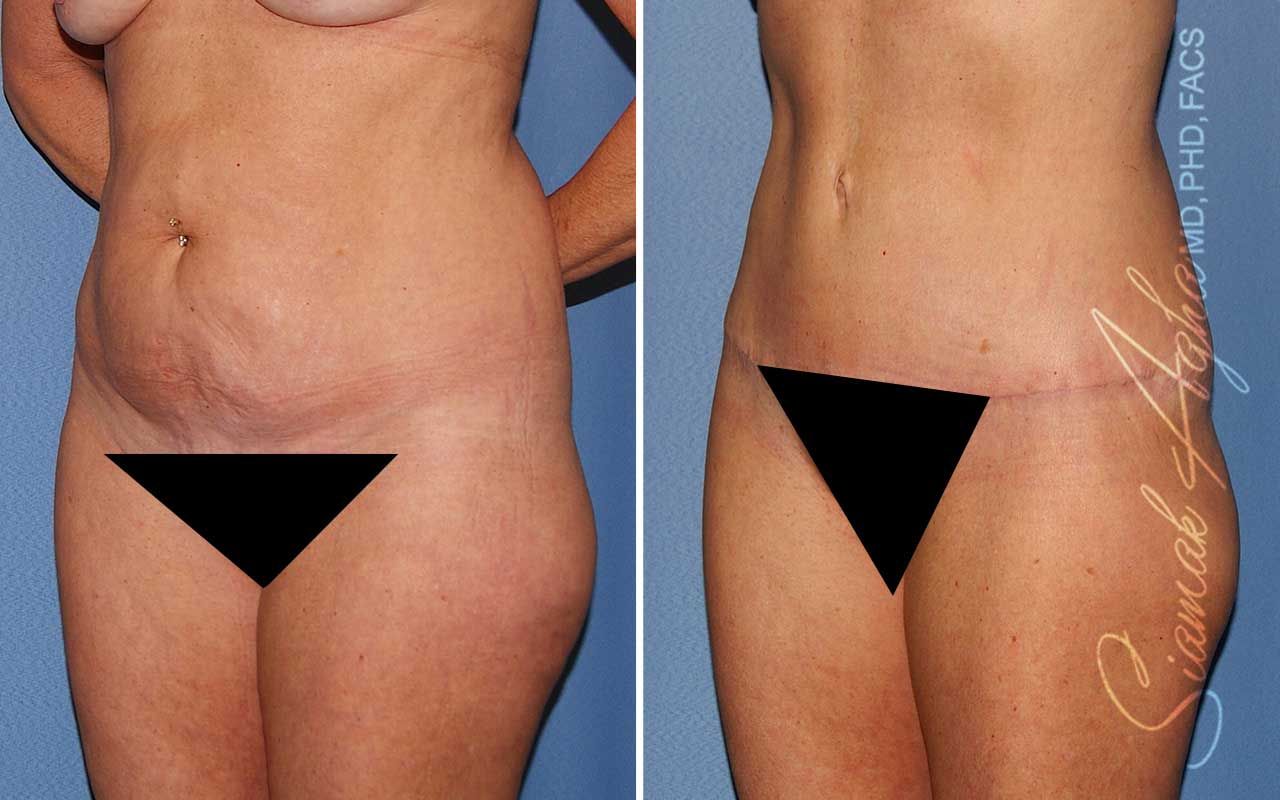 Tummy Tuck Before & After