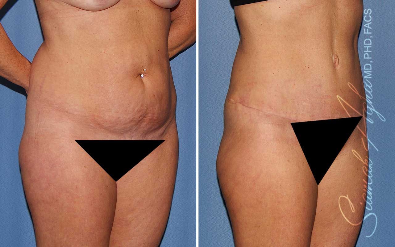 Tummy Tuck Before & After