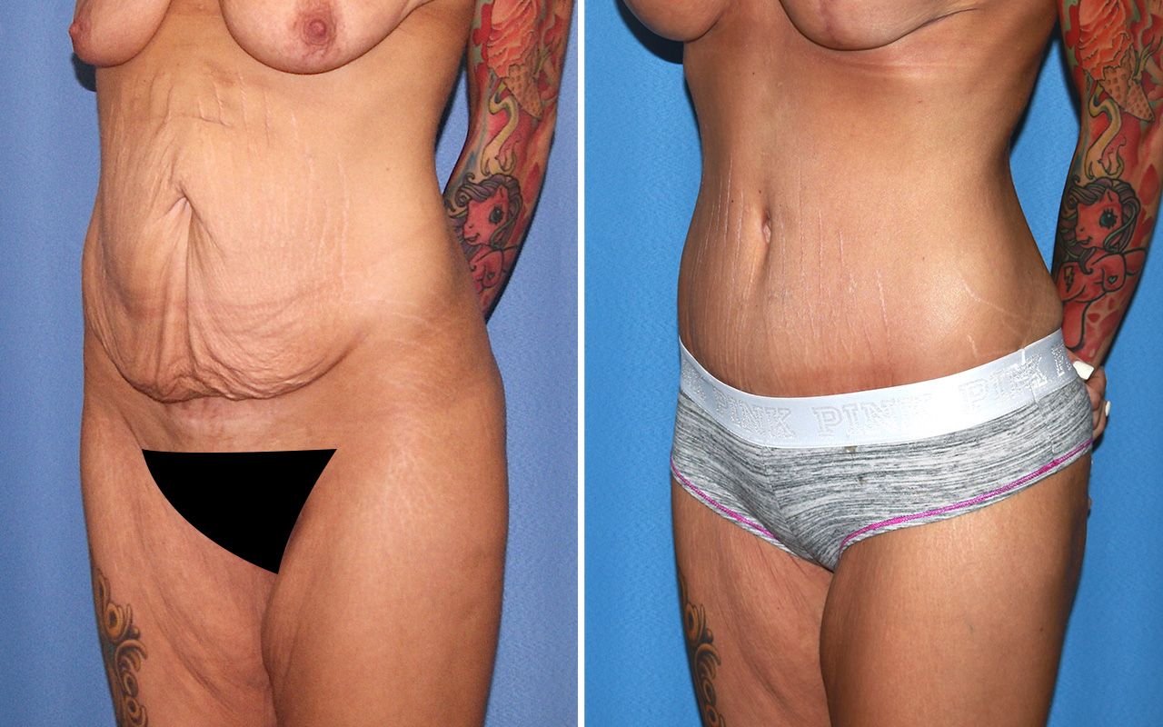 Tummy Tuck Before & After