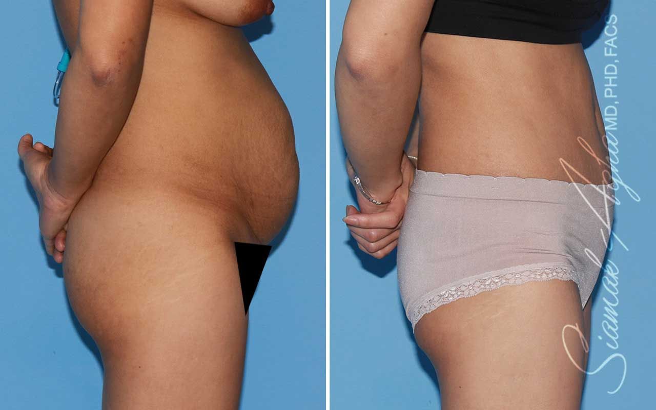 Tummy Tuck Before & After