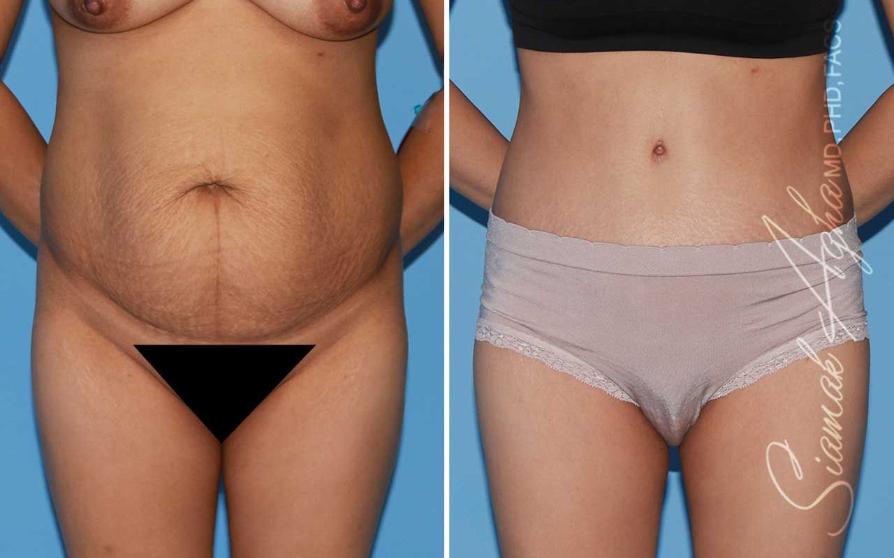 Tummy Tuck Before & After