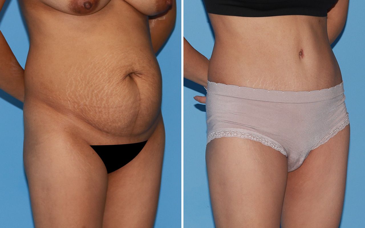 Tummy Tuck Before & After