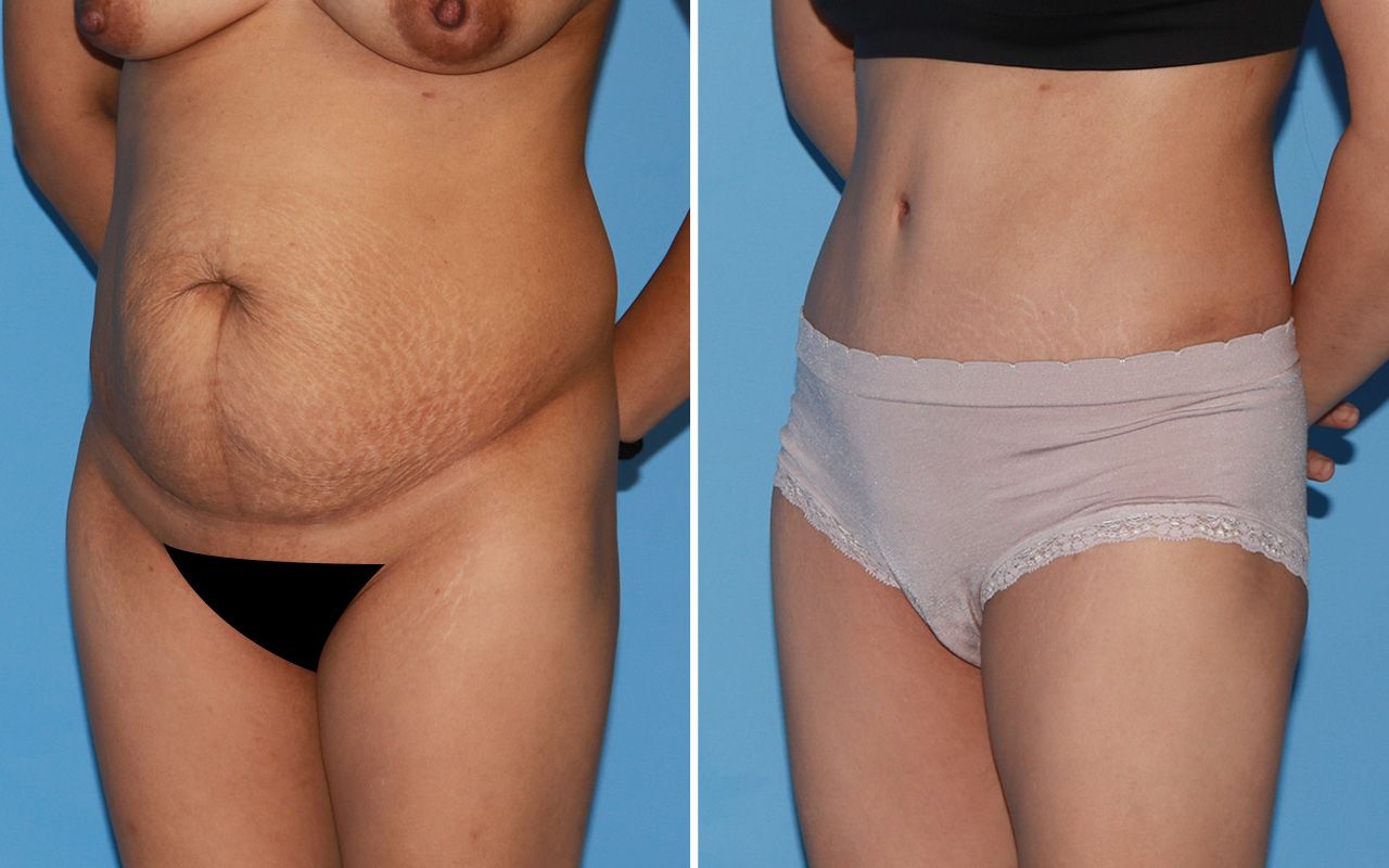 Tummy Tuck Before & After