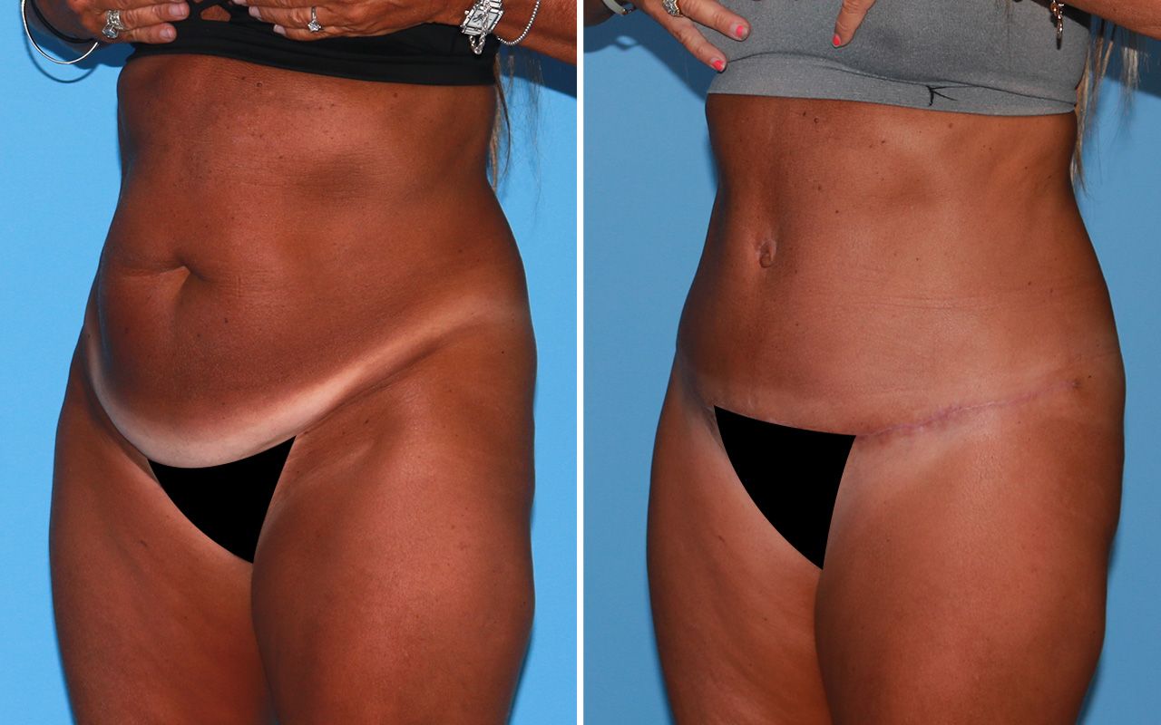 Tummy Tuck Before & After