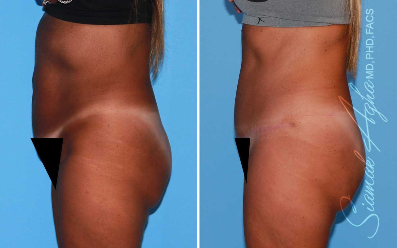 Tummy Tuck Before & After