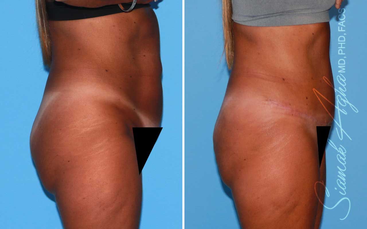 Tummy Tuck Before & After