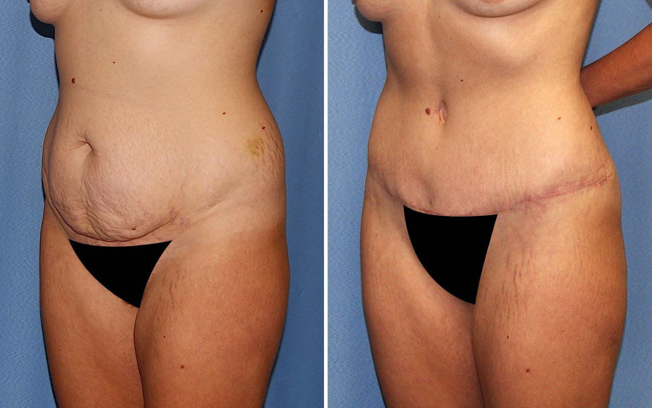 Tummy Tuck Before & After