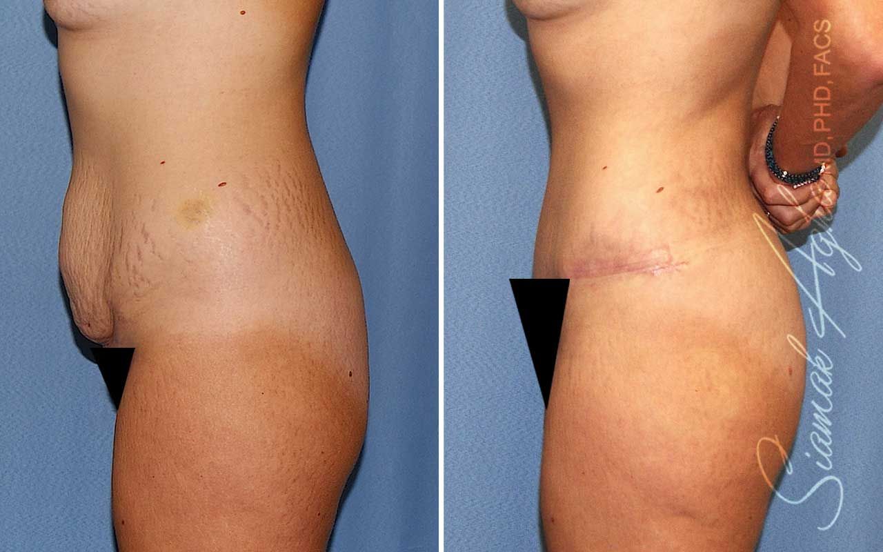 Tummy Tuck Before & After