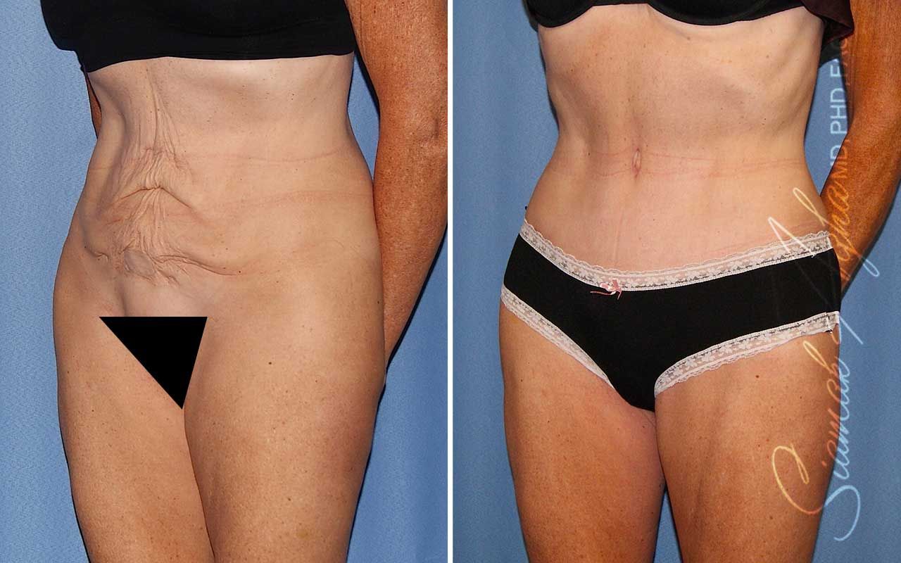Tummy Tuck Before & After