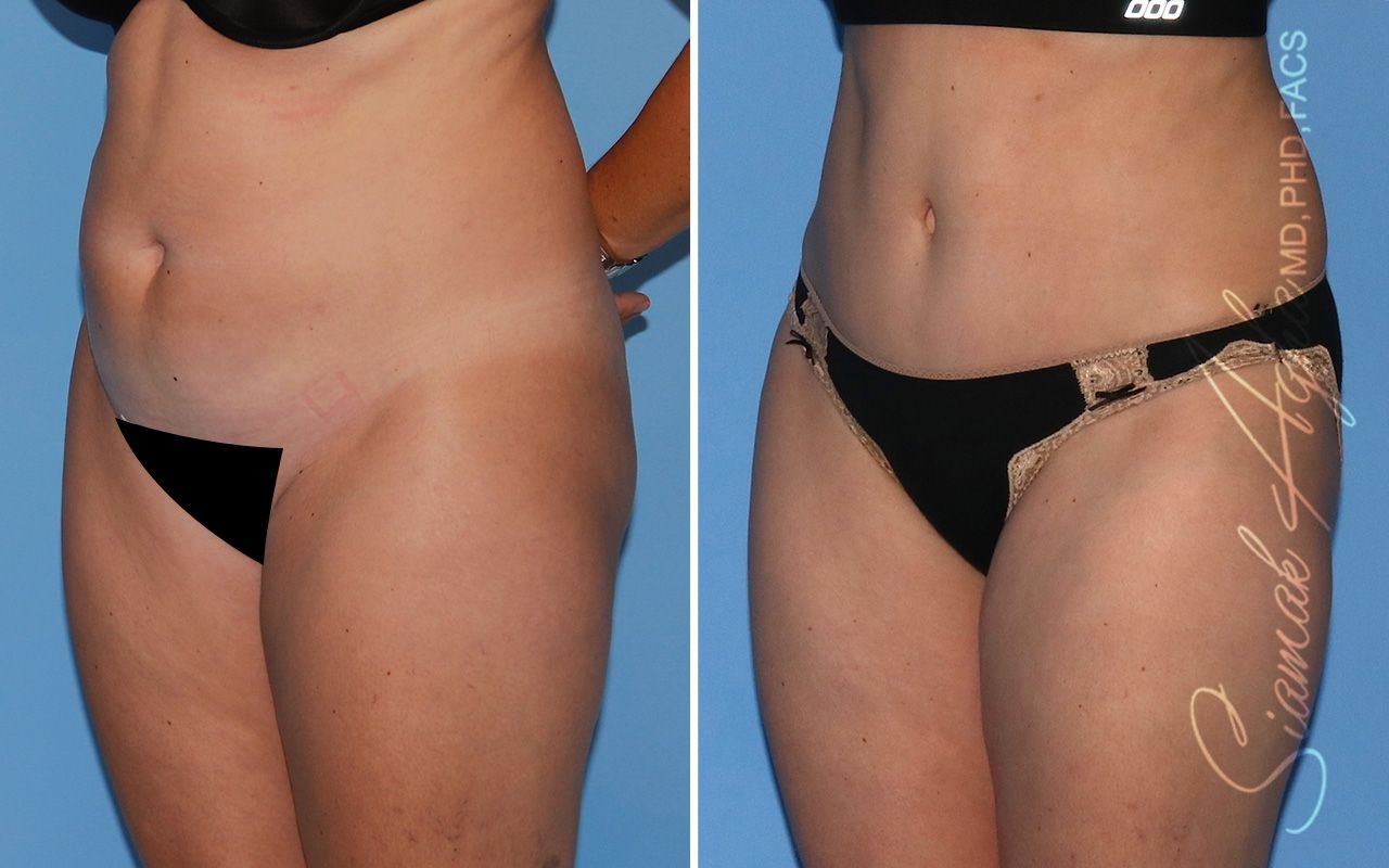 Tummy Tuck Before & After