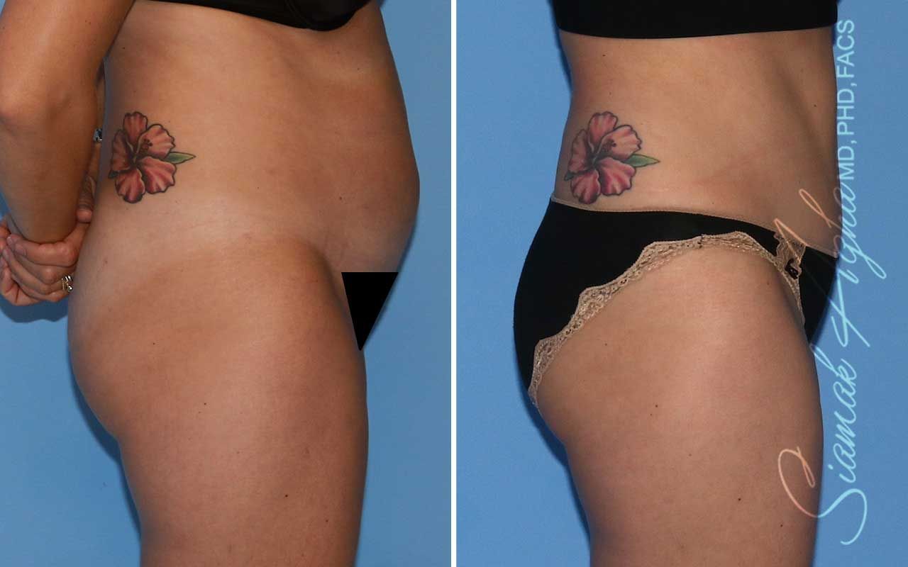 Tummy Tuck Before & After