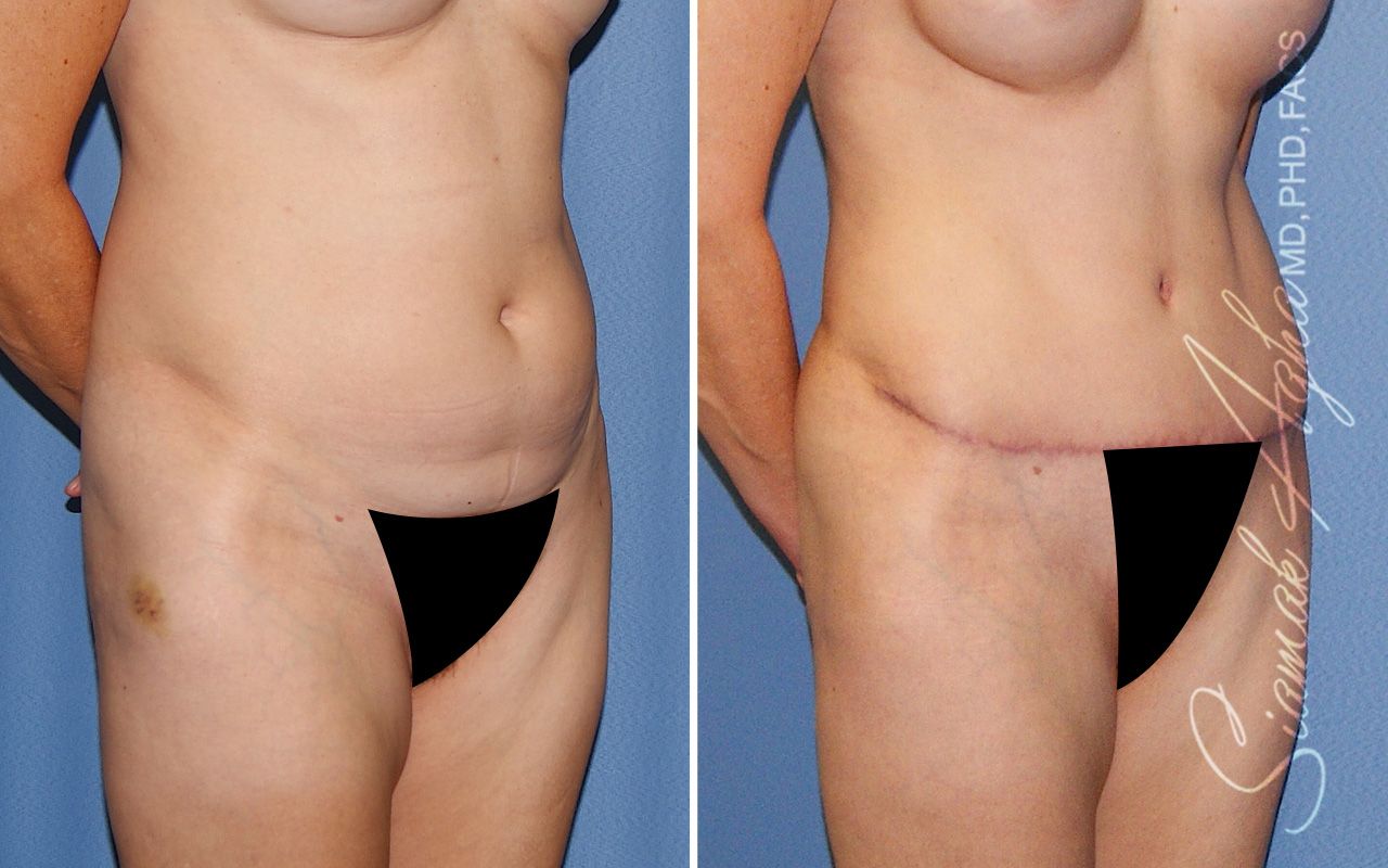 Tummy Tuck Before & After
