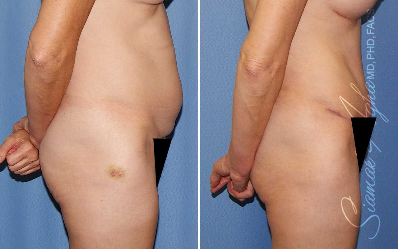 Tummy Tuck Before & After
