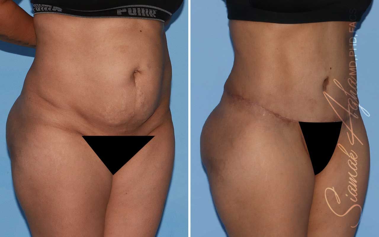 Tummy Tuck Before & After
