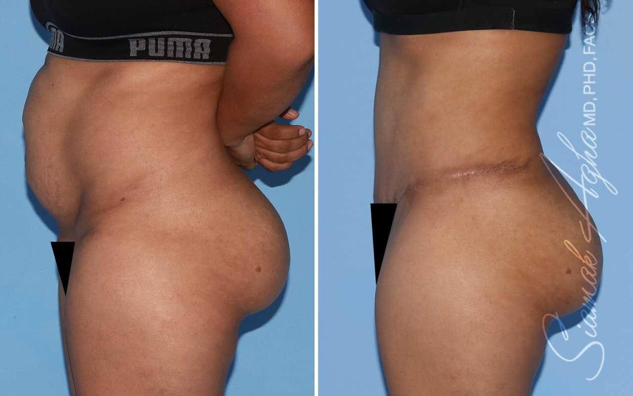 Tummy Tuck Before & After