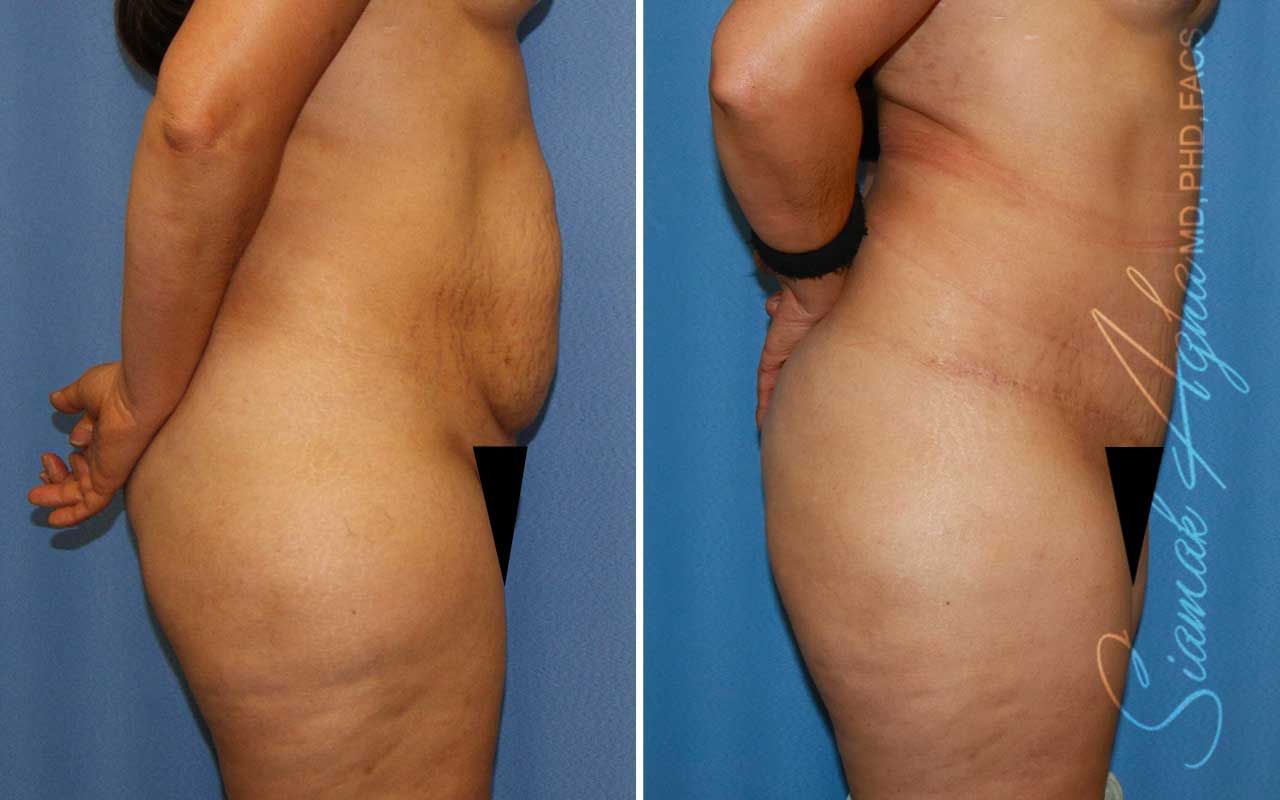 Tummy Tuck Before & After