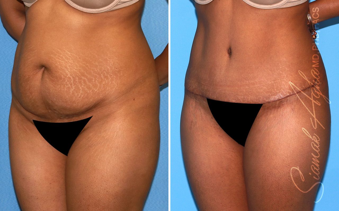 Tummy Tuck Before & After