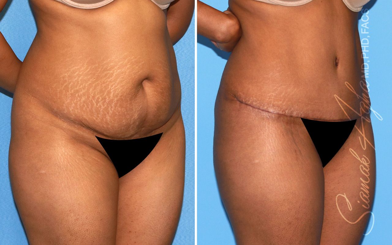 Tummy Tuck Before & After