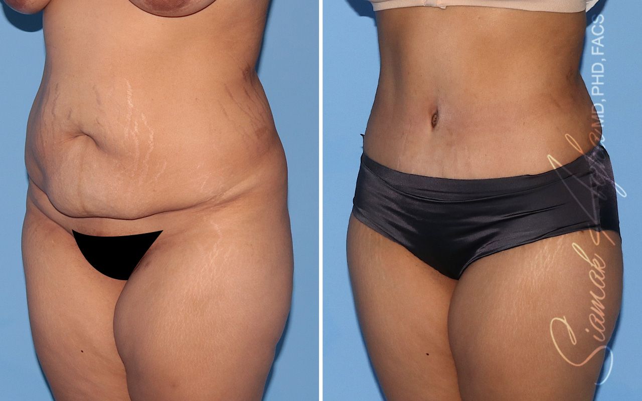 Tummy Tuck Before & After