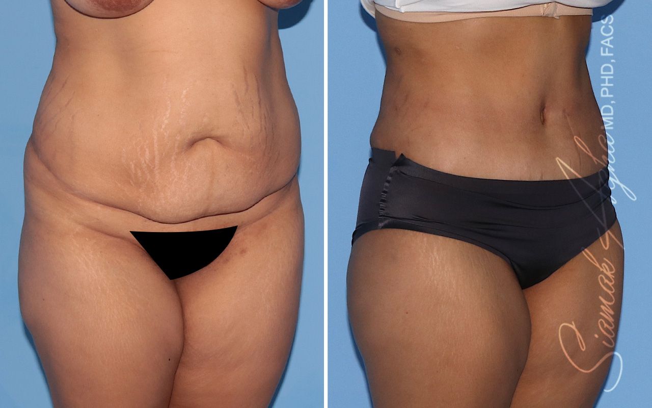 Tummy Tuck Before & After