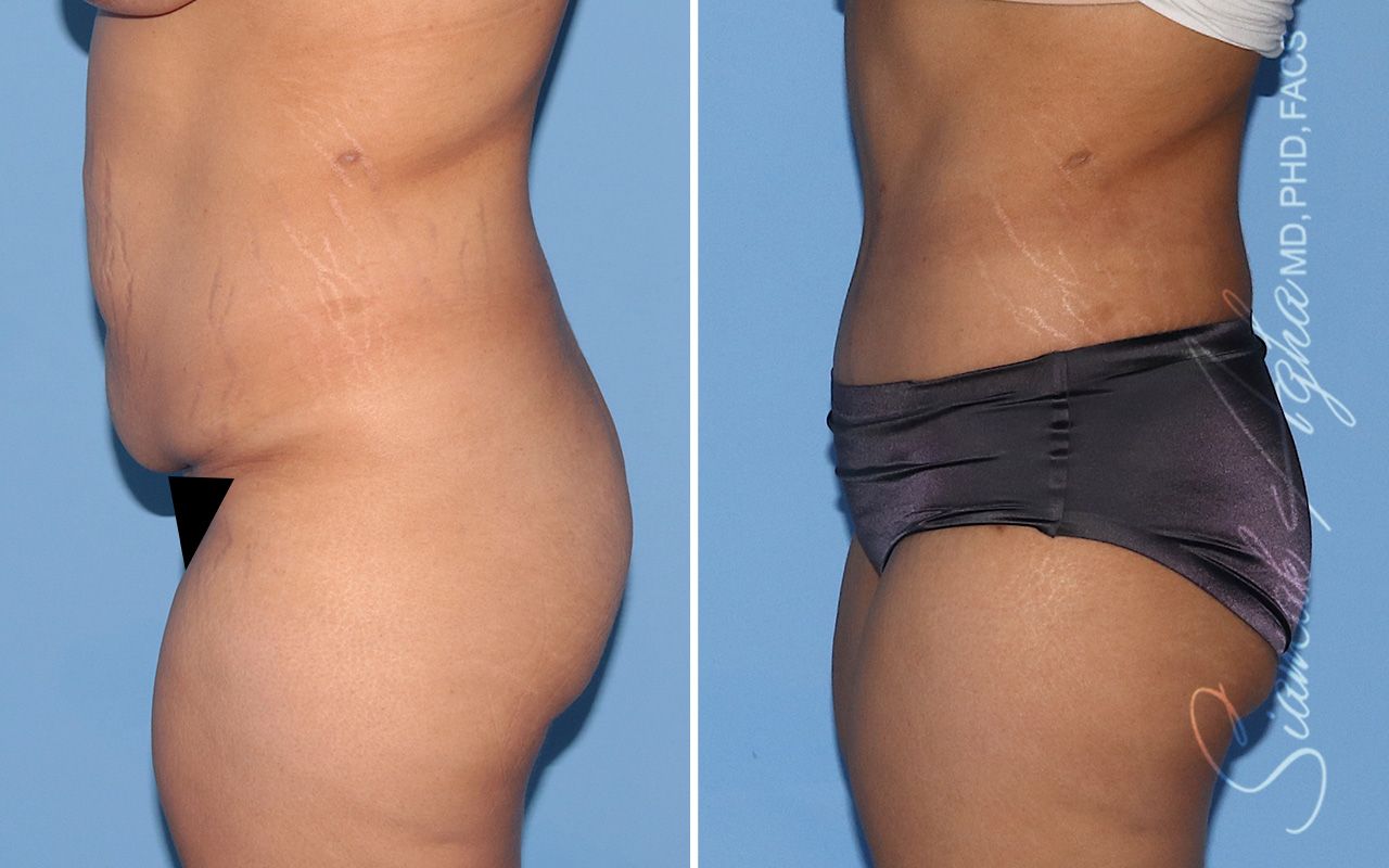 Tummy Tuck Before & After