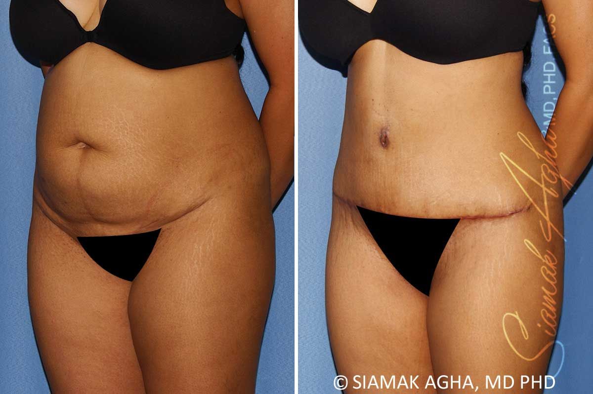 Tummy Tuck Before & After