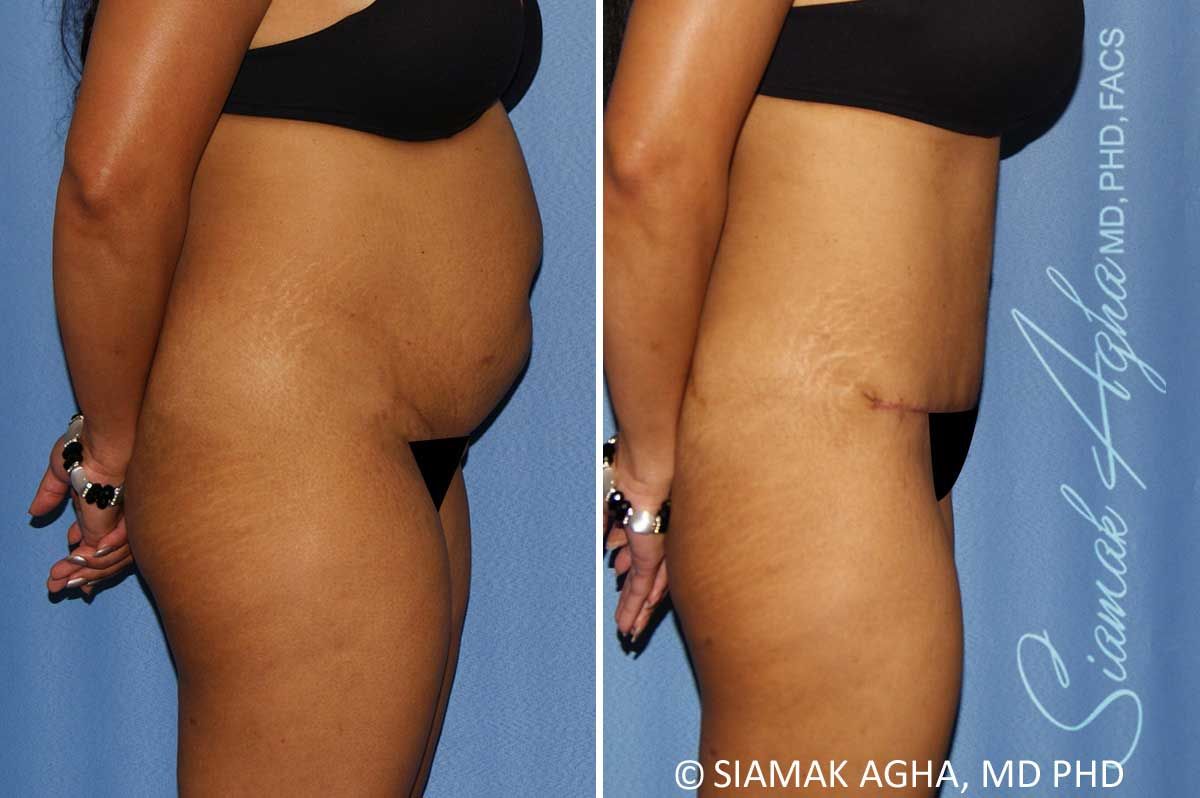 Tummy Tuck Before & After