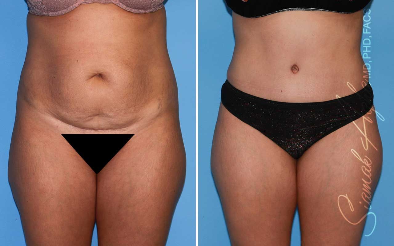 Tummy Tuck Before & After