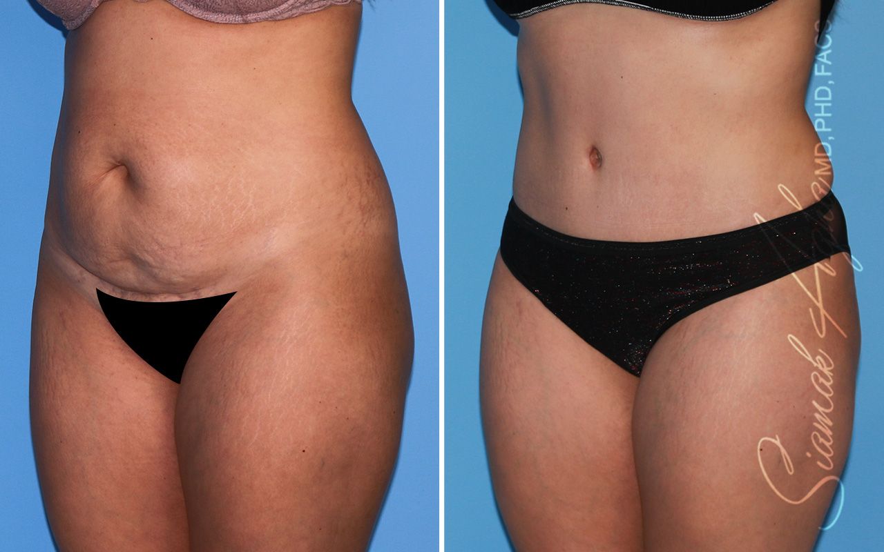 Tummy Tuck Before & After