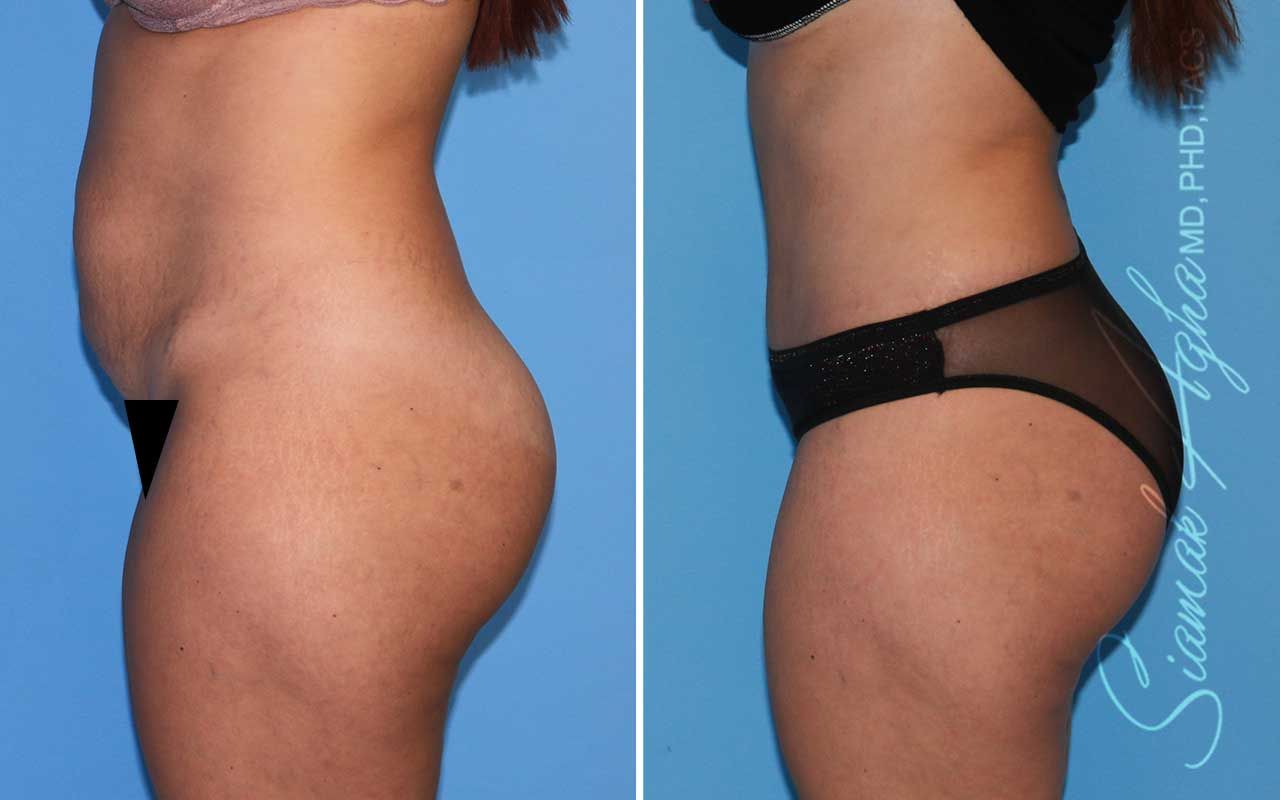 Tummy Tuck Before & After