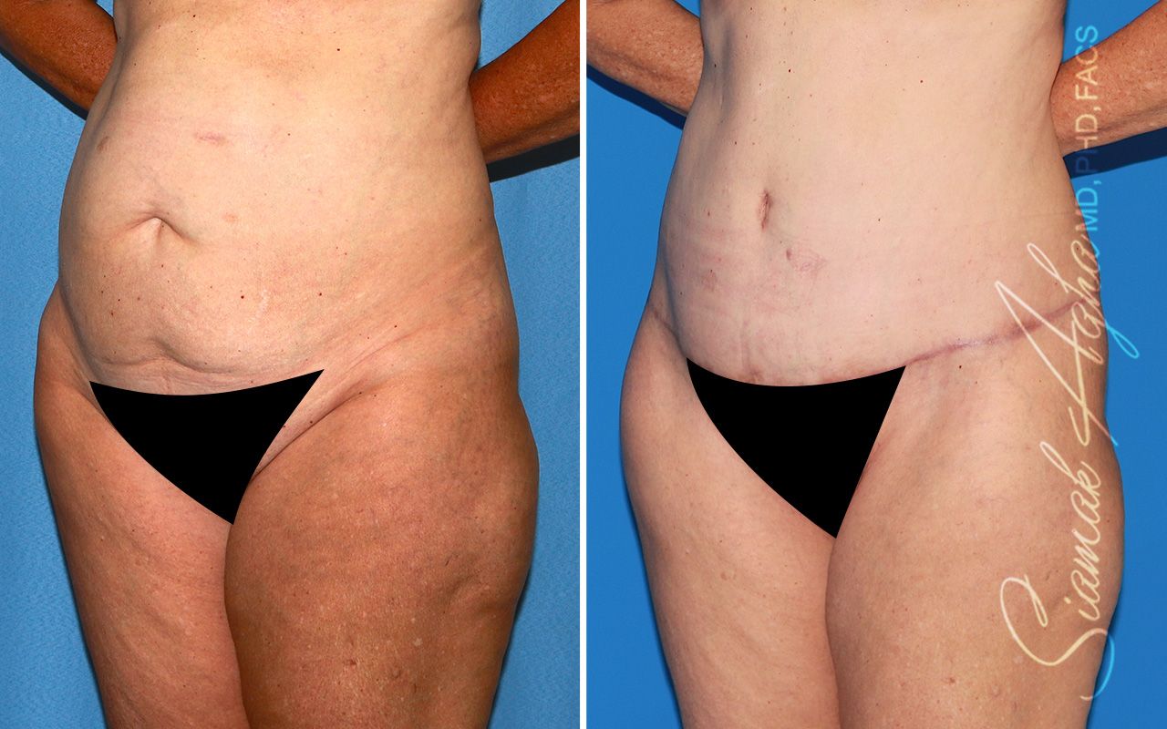 Tummy Tuck Before & After