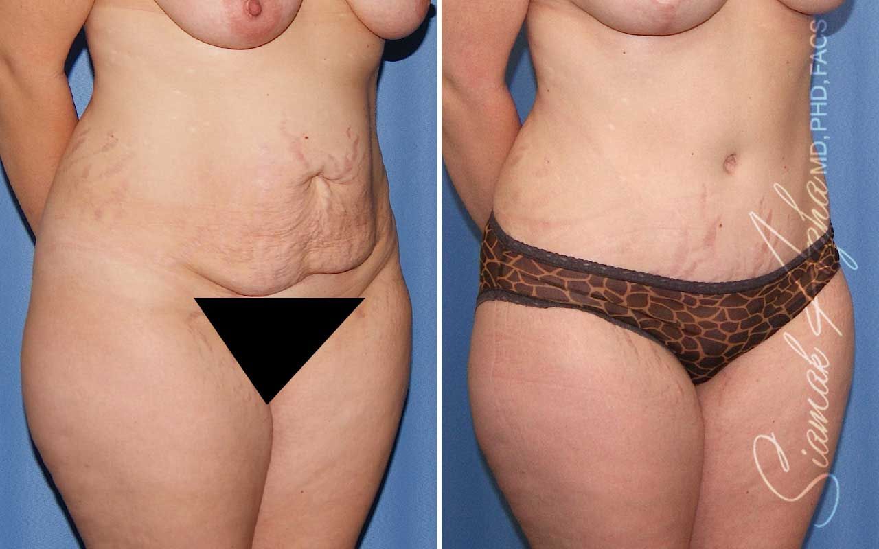Tummy Tuck Before & After