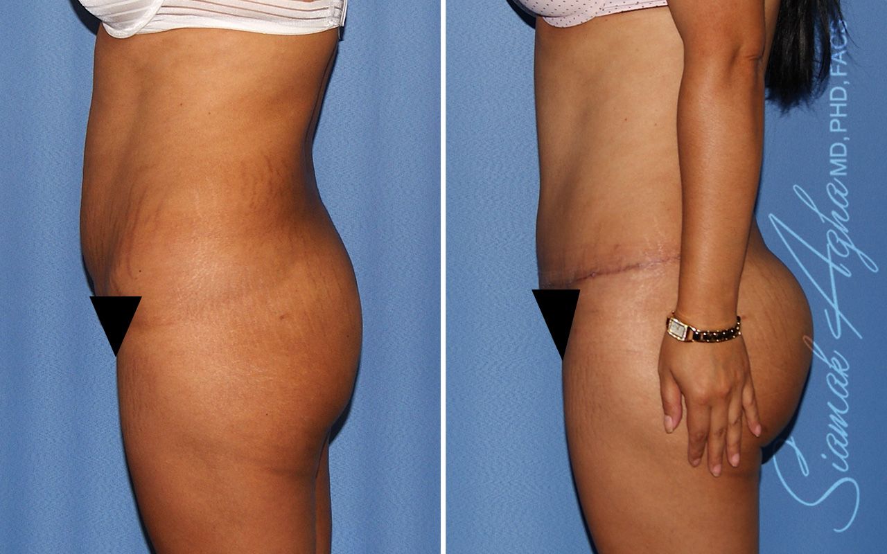 Tummy Tuck Before & After