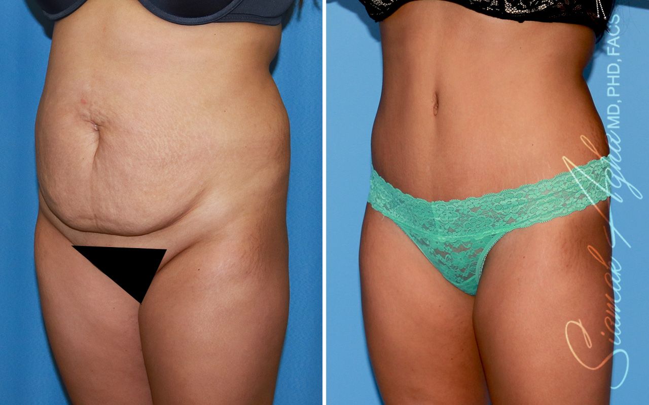 Tummy Tuck Before & After