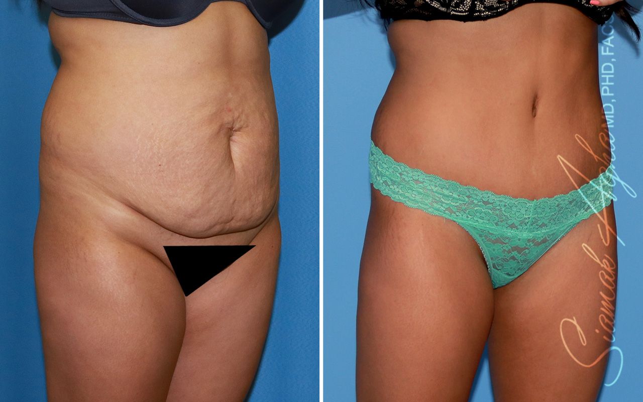 Tummy Tuck Before & After