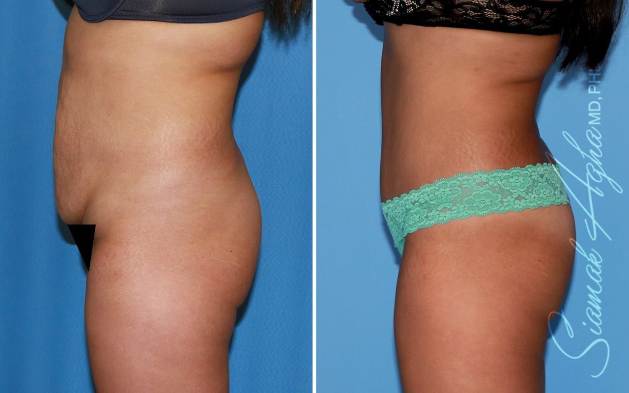 Tummy Tuck Before & After