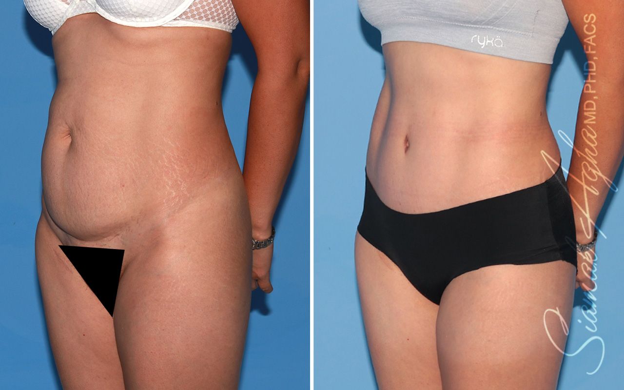 Tummy Tuck Before & After