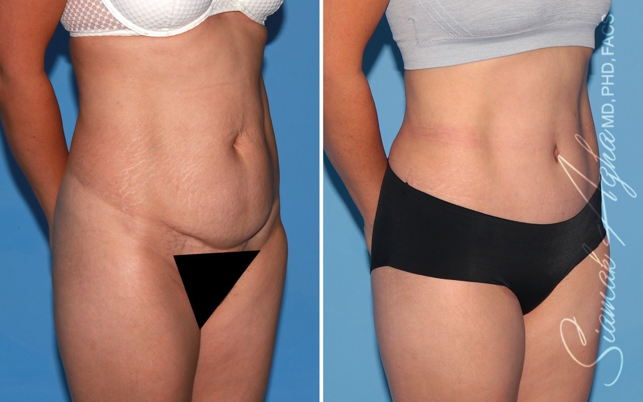 Tummy Tuck Before & After