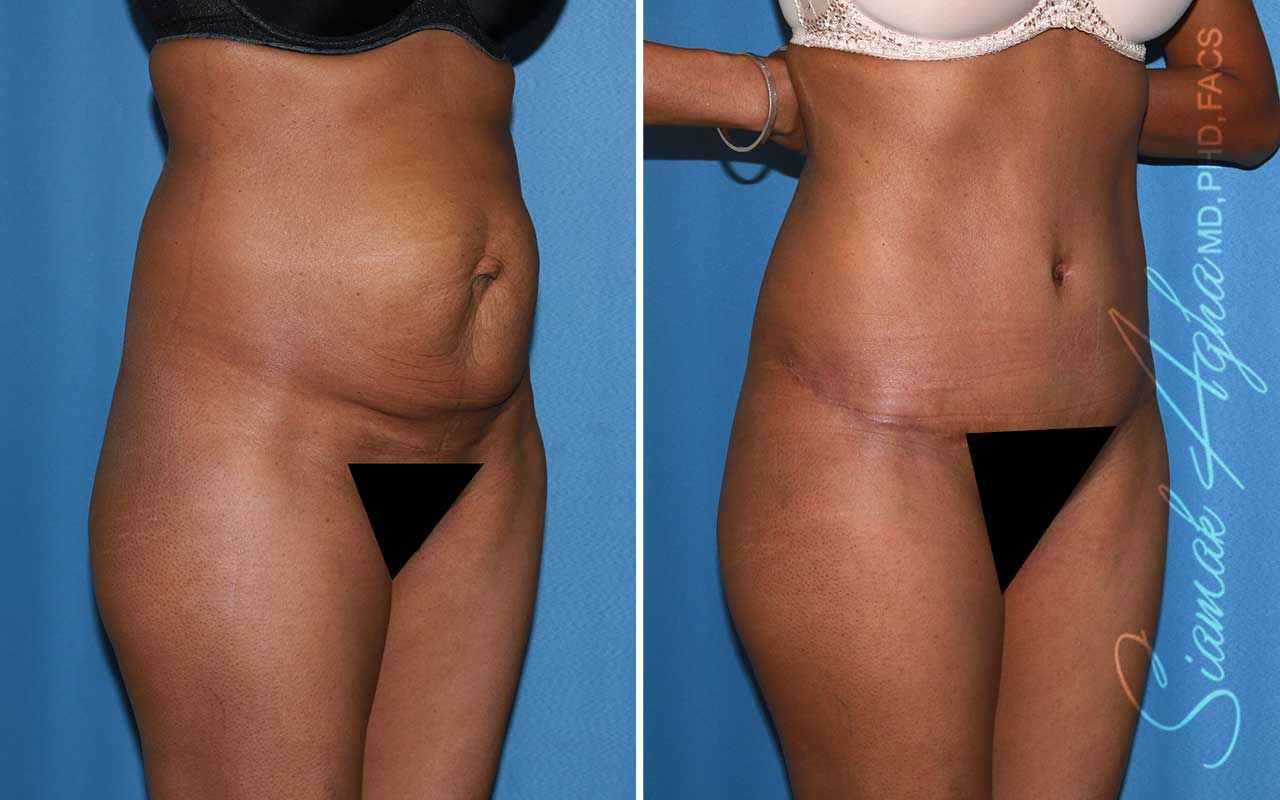 Tummy Tuck Before & After